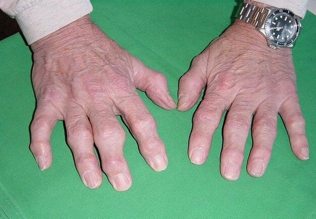 Οστεοαρθρίτιδα των δακτύλων