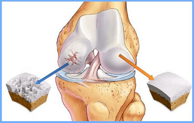 Κανονική άρθρωση του γόνατος και επηρεάζεται από αρθρίτιδα